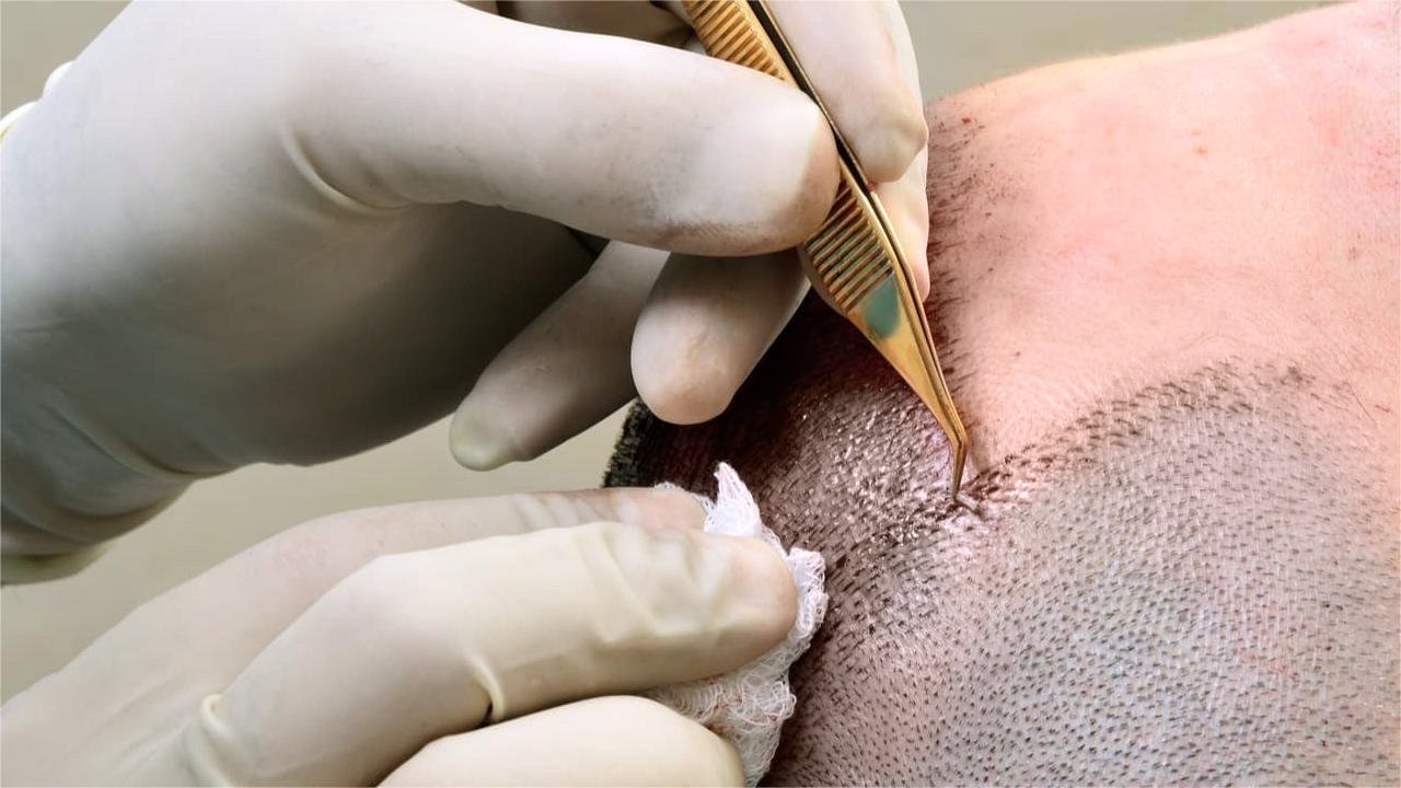 Diplomado en Implante Capilar Técnica FUE único con Práctico Cadavérico